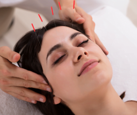 Acupuncture for PCOS : Different Techniques, Benefits and Limitations