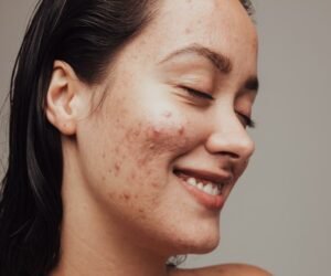 Why Does PCOS Trigger Acne?