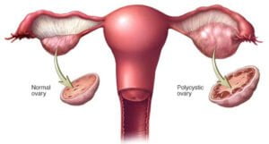 Defining PCOD and PCOS