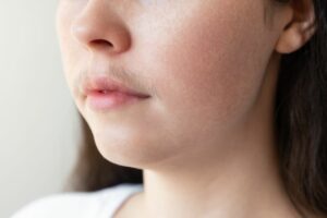 What Is Hirsutism?