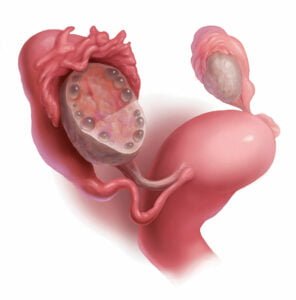 What Are Some Examples of Medicine For Polycystic Ovaries?