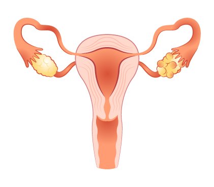 What Are the Complex Causes of Polycystic Ovary Syndrome? Signs To Look For