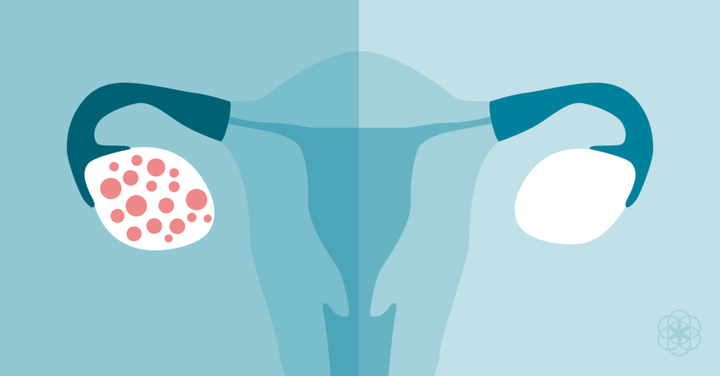 PCOS Heavy Periods Treatment : Types and How To Choose?