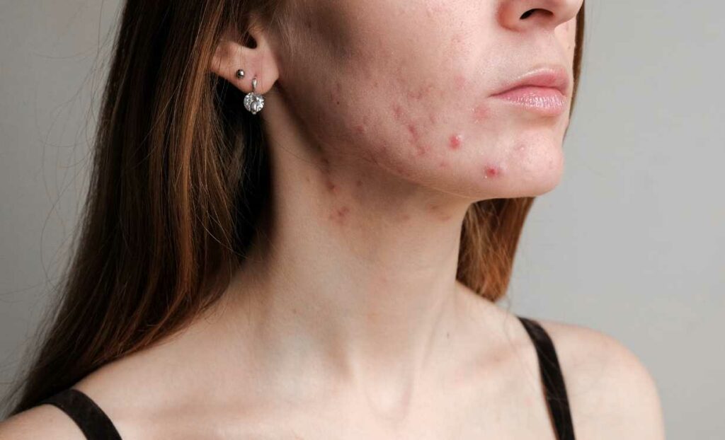 Signs Of PCOS Induced Acne