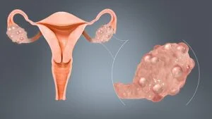 Understanding PCOS Symptoms