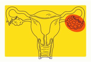 Understanding PCOS and Heavy Periods