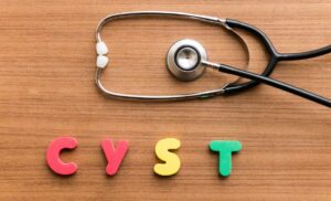 What Causes Ovarian Cysts?