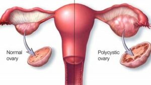 Does Ayurveda Cure PCOS Completely?