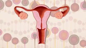What Are The Main PCOS Causes?