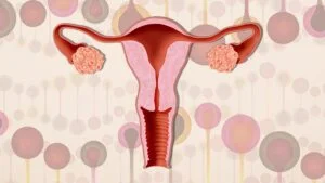 What Are The Main PCOS Causes?