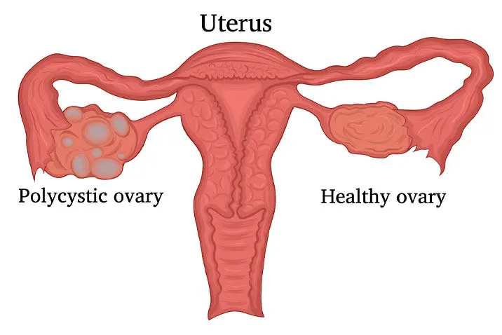 Navigating PCOS: Your Comprehensive Guide to Fertility Success with a Specialist's Insight