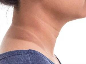 What Is Acanthosis Nigricans PCOS?