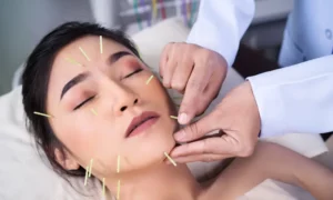 Choosing An Acupuncturist For Hirsutism 