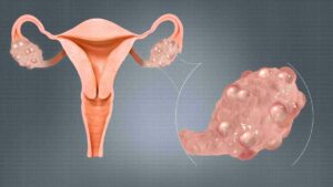 What Are Some Strategies Used In Ovulation Induction In PCOS?