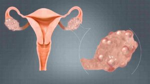 Is Polycystic Ovarian Syndrome Completely Curable?