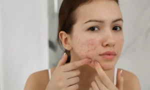 Understanding PCOS Related Acne 