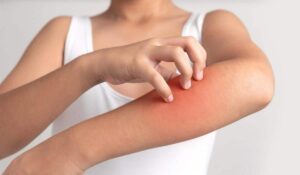 What Does "Menopause Rash" Mean?