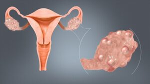 What is High LH PCOS?