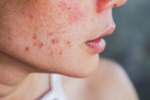 Why PCOS Skin Care Is Important?