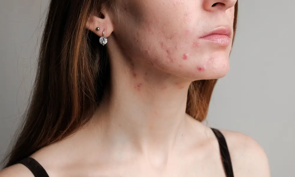 pcos acne home remedies