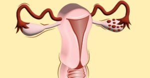 Can Polycystic Ovary Syndrome Be Cured?