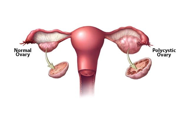 Unveiling Hope: Exploring Polycystic Ovary Syndrome Treatments