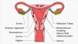 When Should I Seek Medical Attention For Endometriosis Menopause?