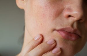 Importance Of Best Skin For PCOS