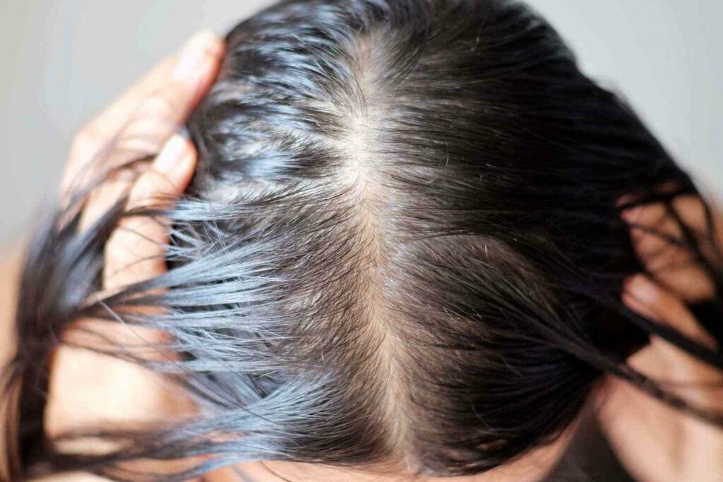 Perimenopause Hair Loss Treatment with Natural Remedies