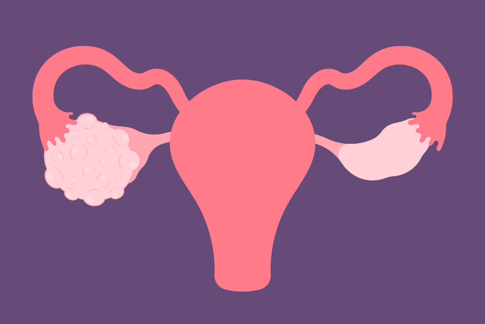 Functional Medicine Approach to Polycystic Ovary Syndrome (PCOS)